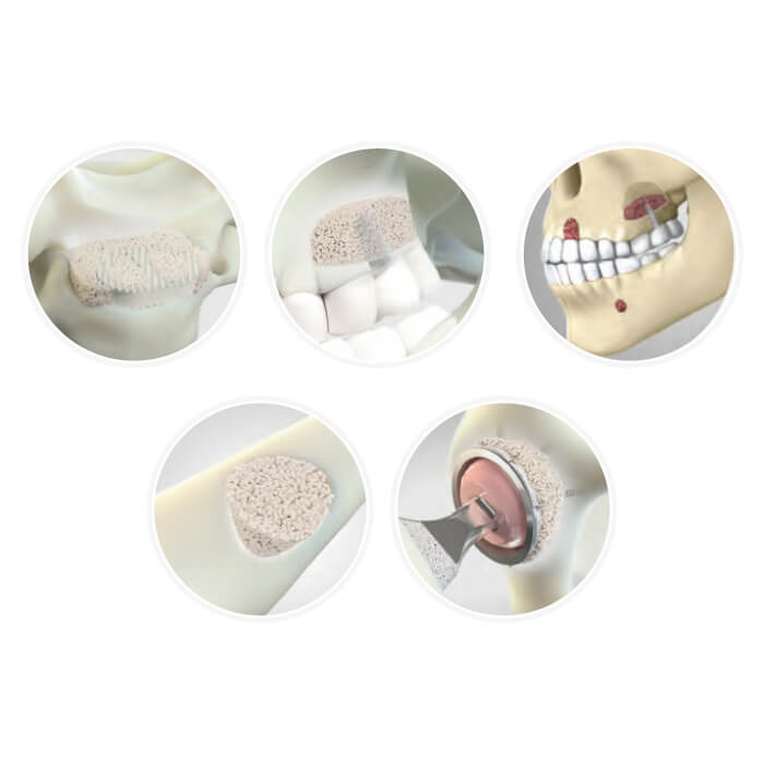 Ecucomed-Equipos-e-Instrumental-medico-en-Quito-Ecuador-GLASSBONE-PUTTY-02